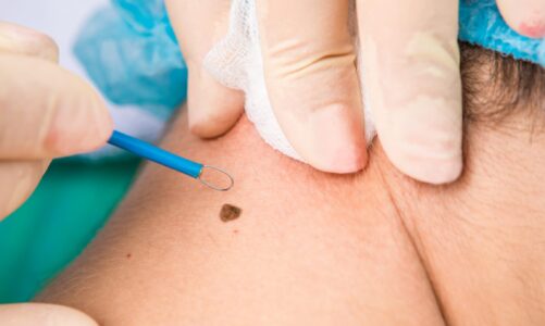 Mole Removal Procedure- What Are The Options?
