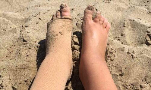 Purpose of waring compression sleeves in Lymphedema