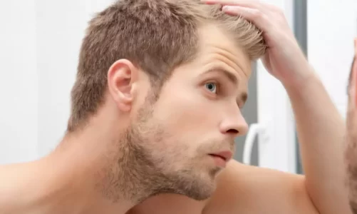 Common causes for hair loss in men
