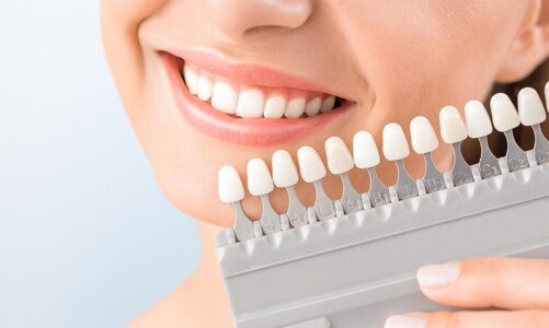 What Steps Are Involved In Creating Dental Veneers