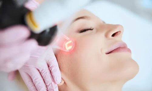 Flawless Skin, Unveiled: Fractional CO2 Laser Resurfacing Revealed