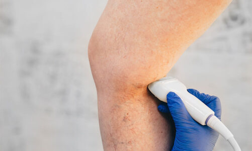 Lifestyle Changes to Prevent Varicose Veins in Upper East Side: Your Path to Healthy Circulation