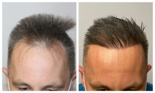 Turkey Hair Transplant Clinics - How To Pick The Right One