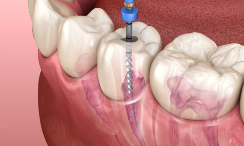 Understanding Root Canal Treatment with a General Dentist