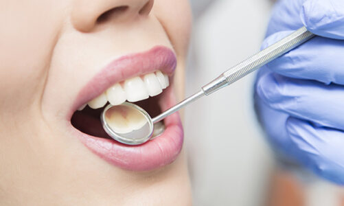 The Crucial Role of General Dentists in Oral Cancer Screening