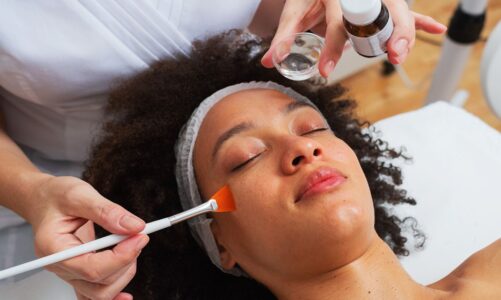 Ultimate Guide to Acne Scar Treatment Options