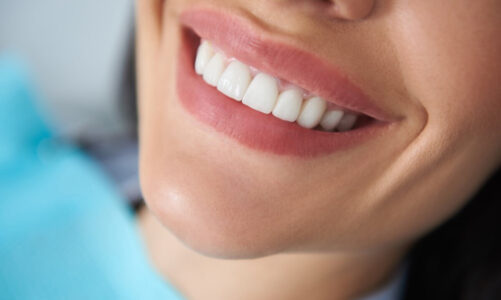 Transforming Smiles: The Impact of Gum Reshaping on Your Appearance in Memphis
