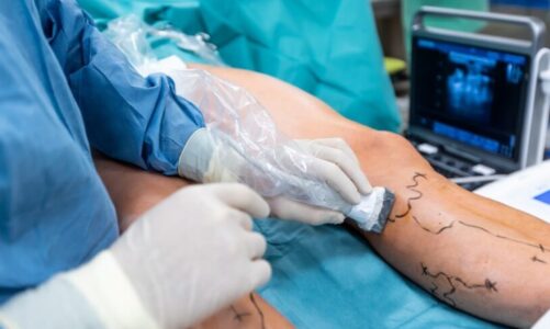 Emerging Technologies in Endovenous Vein Treatment: The Future of Vein Care