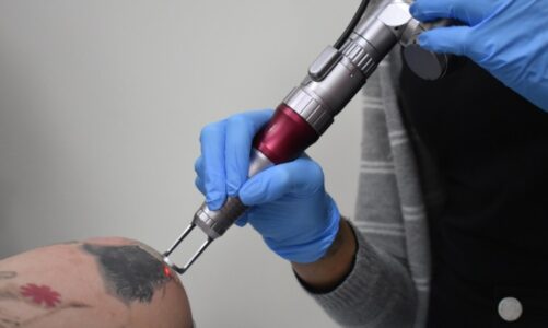 Neatcell Tattoo Removal Pen Reviews (2024): Scam or Legit?