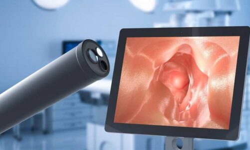 How Colonoscopy Screening Detects and Prevents Polyps