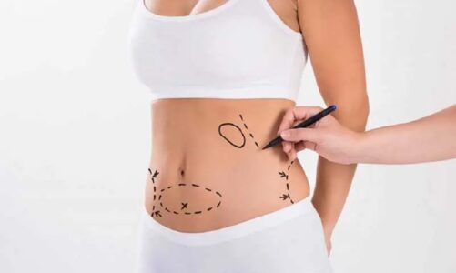 Breaking Down the Cost of Vaser Liposuction: What to Expect?