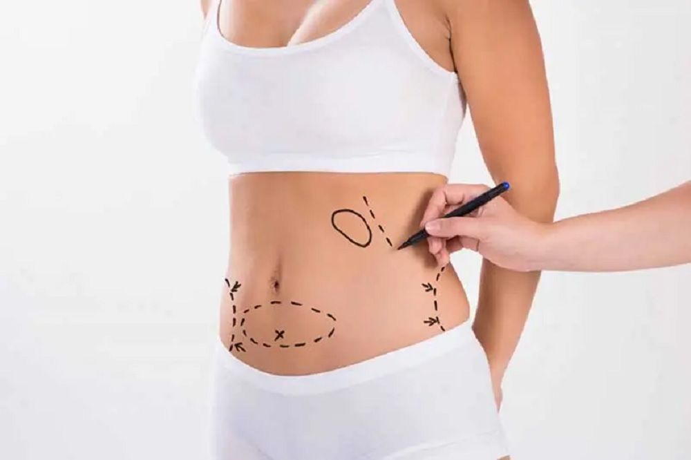 Vaser Lipo cost