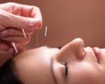 Facial Acupuncture