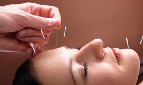 How Facial Acupuncture Supports Holistic Health and Beauty