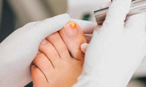 Okita Nail Fungus Light Reviews: What Sets It Apart from Other Remedies?