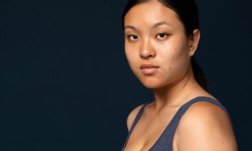 Melasma Myths Debunked: What Cyspera Can and Can’t Do for Your Skin