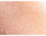 Skin Peeling