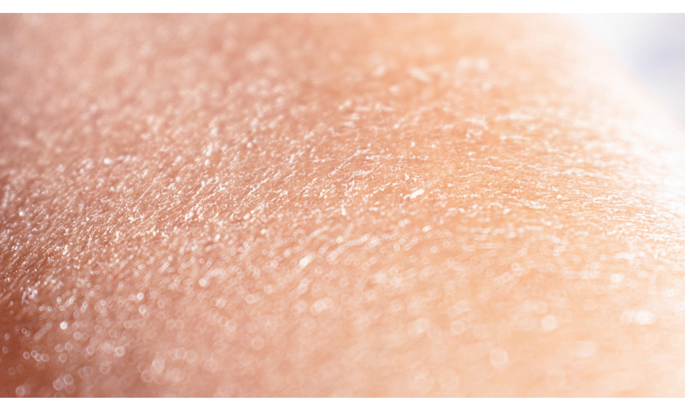 Skin Peeling