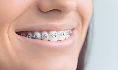 Debunking Common Myths About Metal Braces for Families in Yulee, FL
